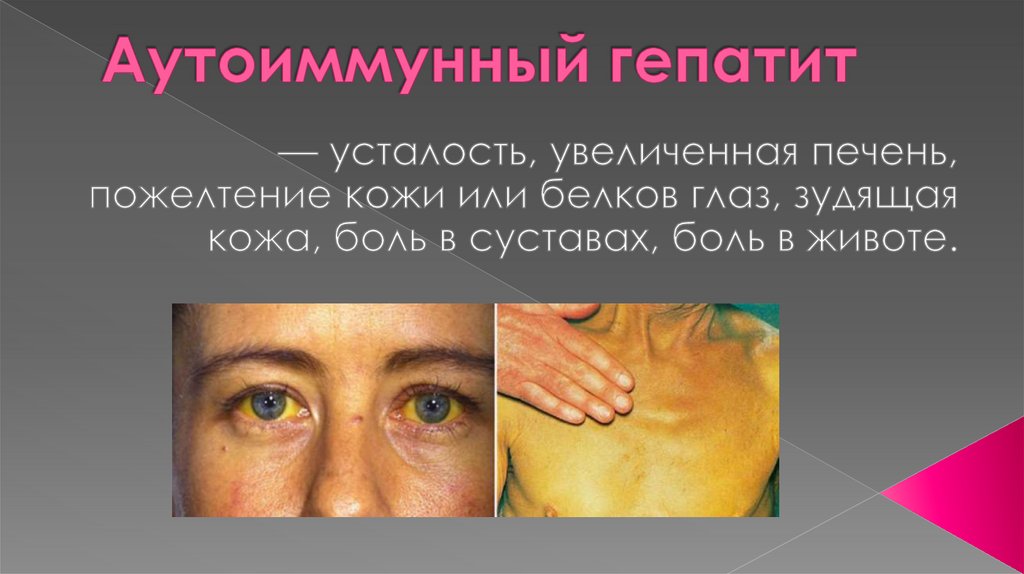 Аутоиммунный гепатит