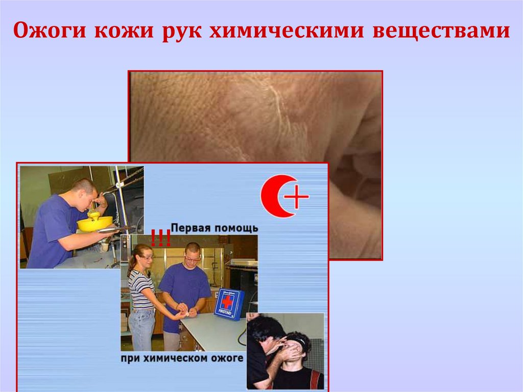 Ожоги кожи рук химическими веществами