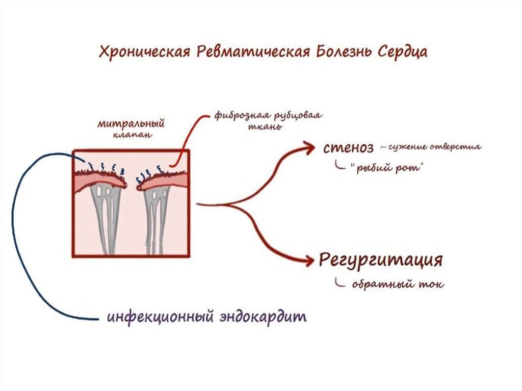 Острая ревматическая лихорадка - презентация онлайн