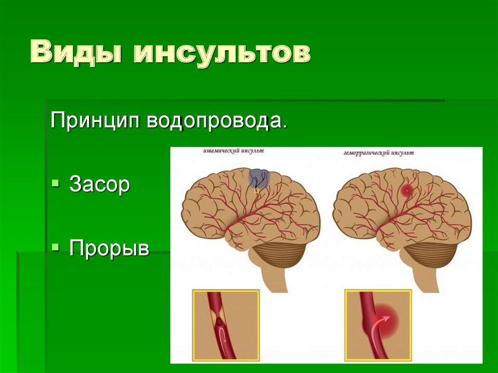 Инсульт мозга последствия