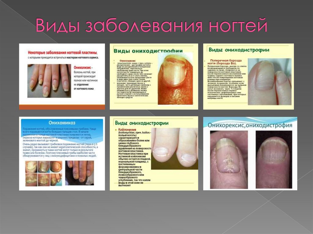 Виды заболевания ногтей