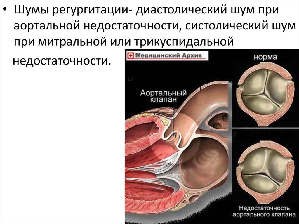 Аортальная трикуспидальная регургитация. Шум регургитации. Шум митральной регургитации. Шум аортальной регургитации. Шум при митральной регургитации.