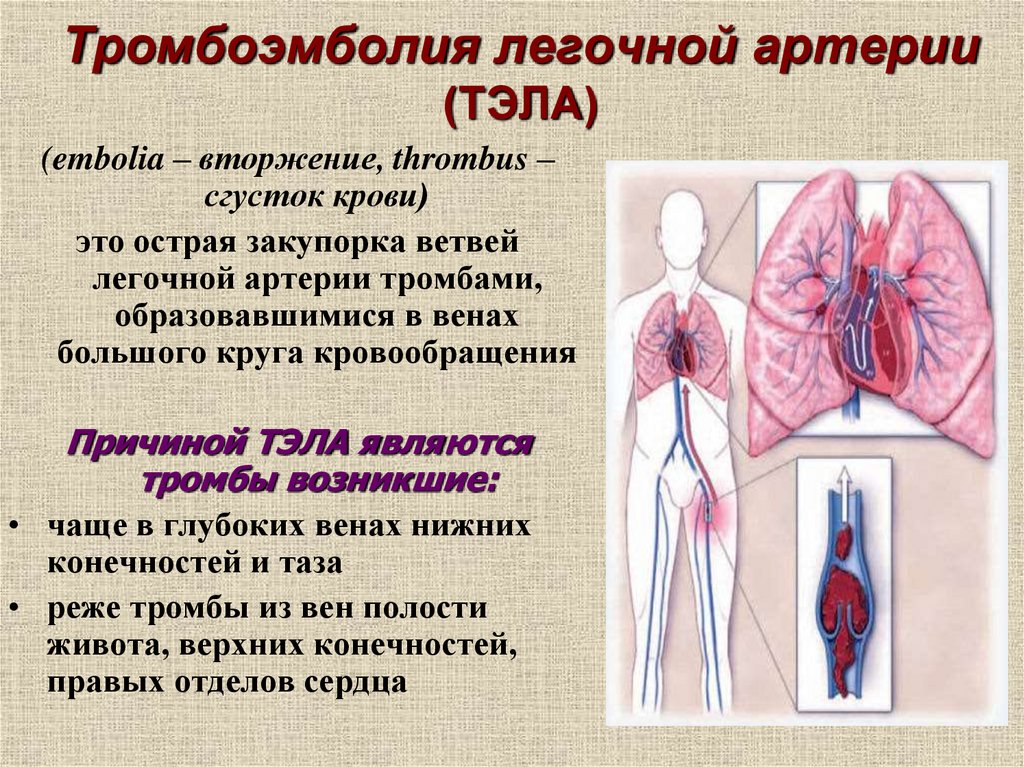 Артериальная тромбоэмболия