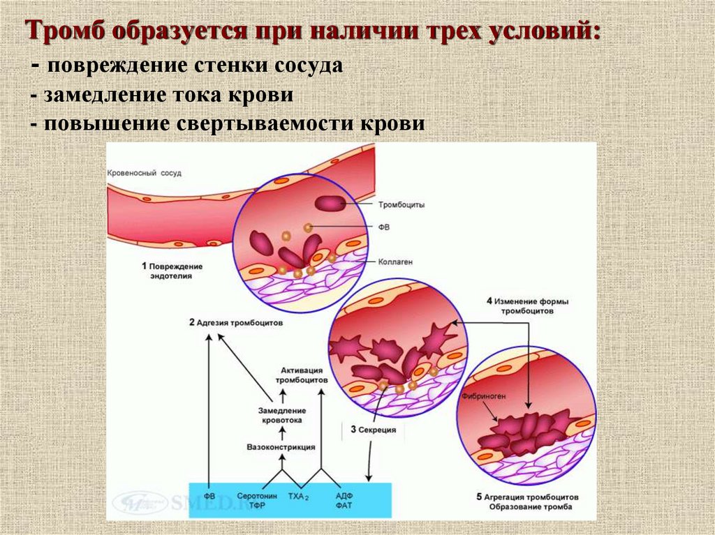 Основной тромб. Схема образования тромба. Процесс образования тромба. Условия образования тромба.