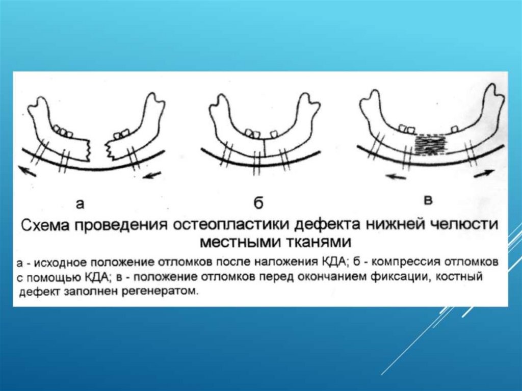 Костная пластика презентация