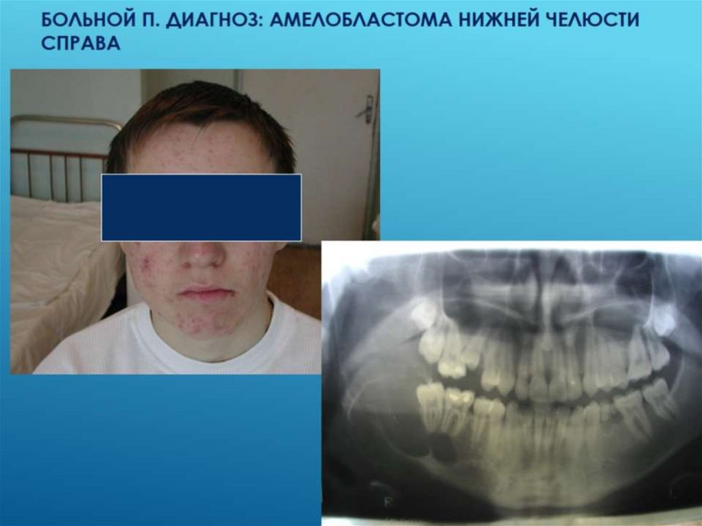 Больной П. диагноз: амелобластома нижней челюсти справа