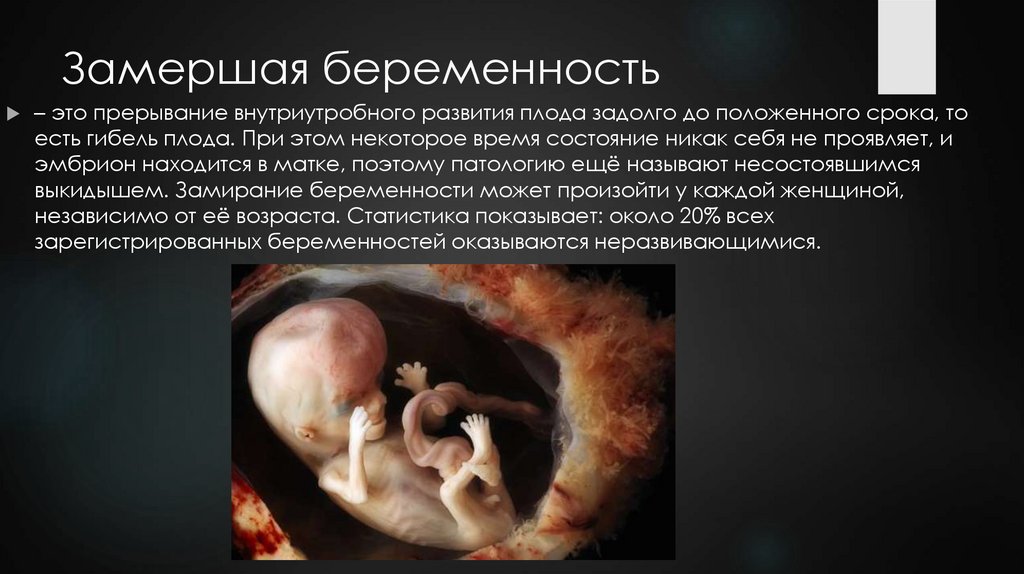 Замершая беременность