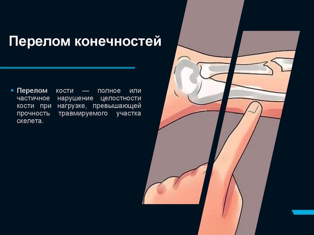 Перелом конечностей
