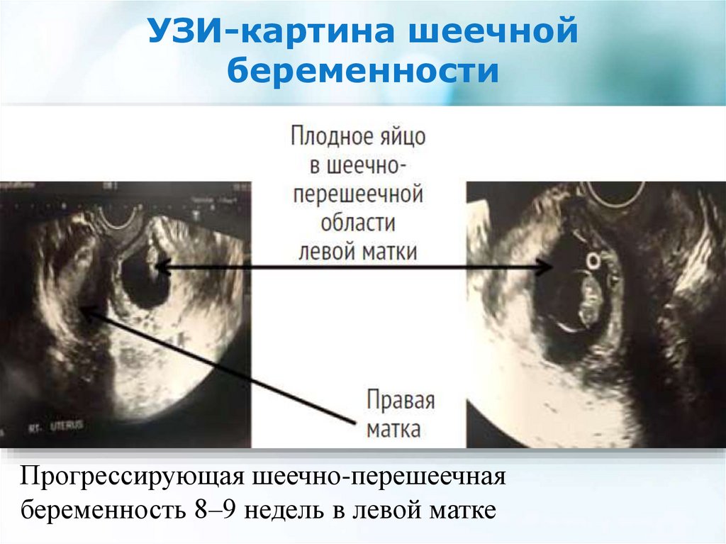 На узи видно внематочную. Шеечная внематочная беременность. Шеечная внематочная беременность УЗИ. Эктопическая шеечная беременность. Шеечная беременность УЗИ.