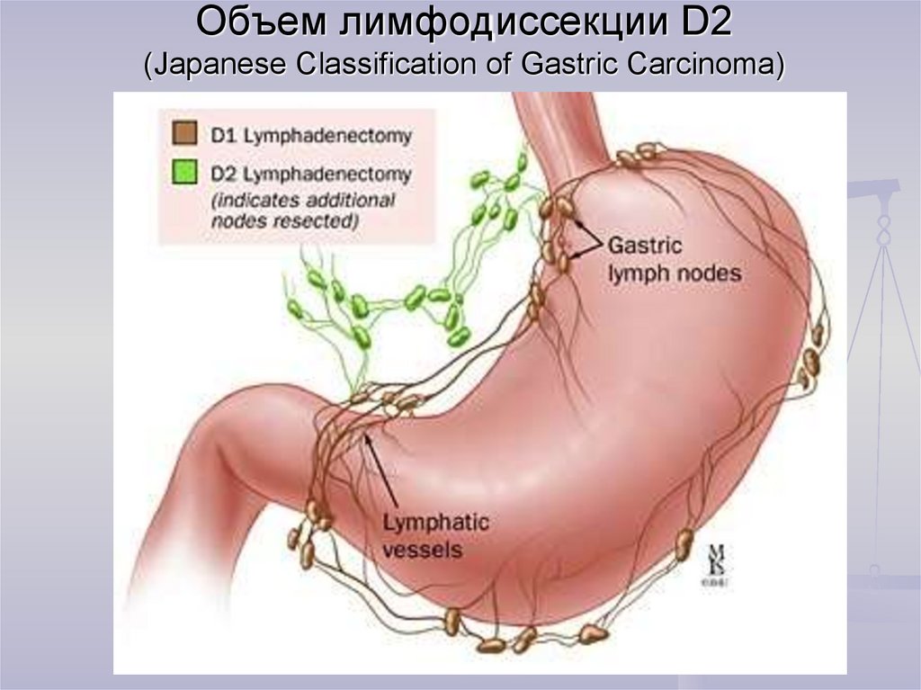 Лимфоузлы пищевода. Лимфатические узлы желудка. Лимфодиссекция желудка.