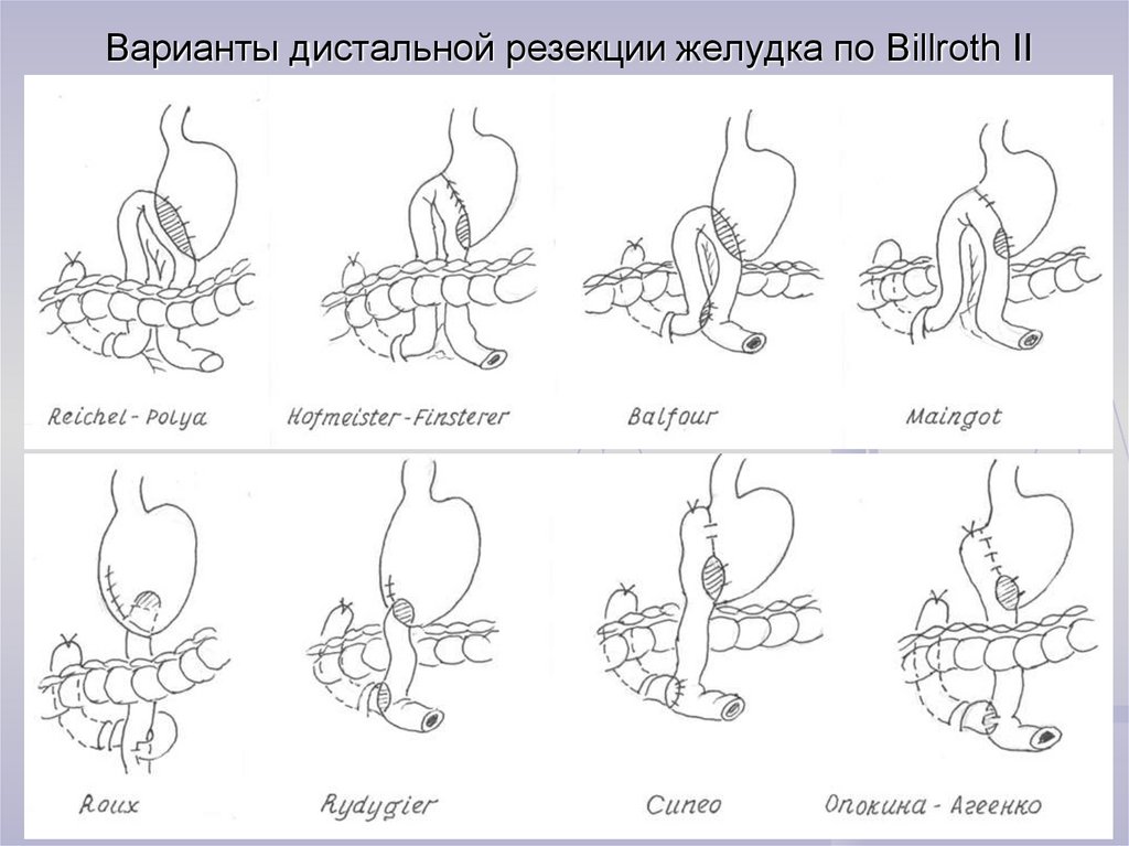 Последствия резекции желудка. Дистальная резекция желудка. Дистальная субтотальная резекция желудка. Проксимальная субтотальная резекция желудка. Резекция желудка по ру.