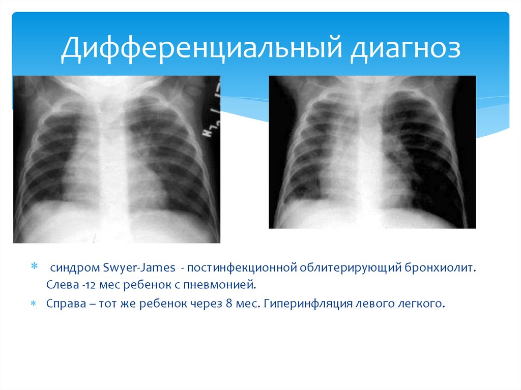 Врожденная лобарная эмфизема клиника рентгенологическая картина принципы лечения