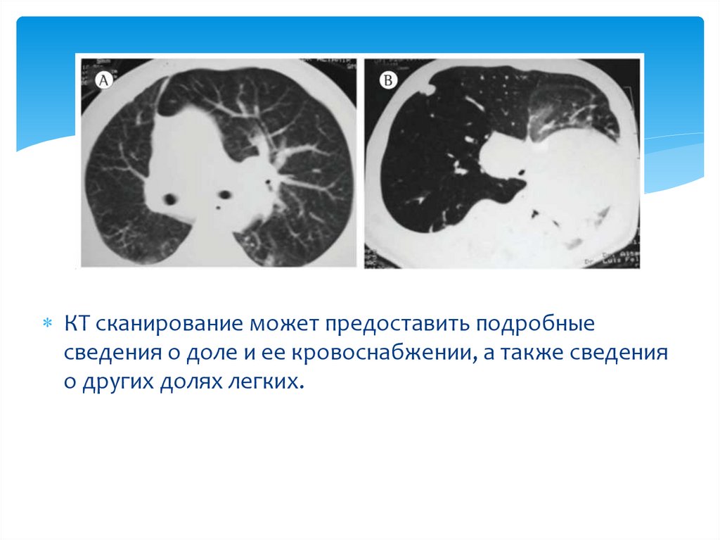 Врожденная лобарная эмфизема клиника рентгенологическая картина принципы лечения