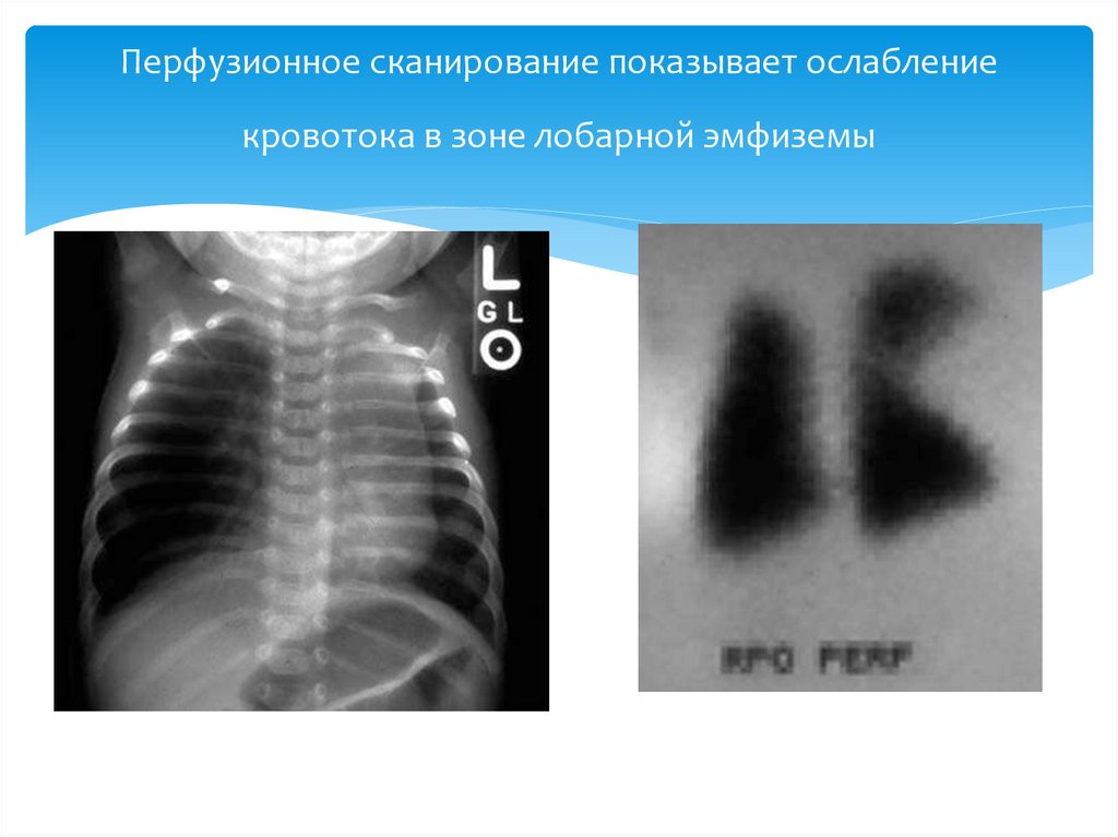 Врожденная лобарная эмфизема клиника рентгенологическая картина принципы лечения