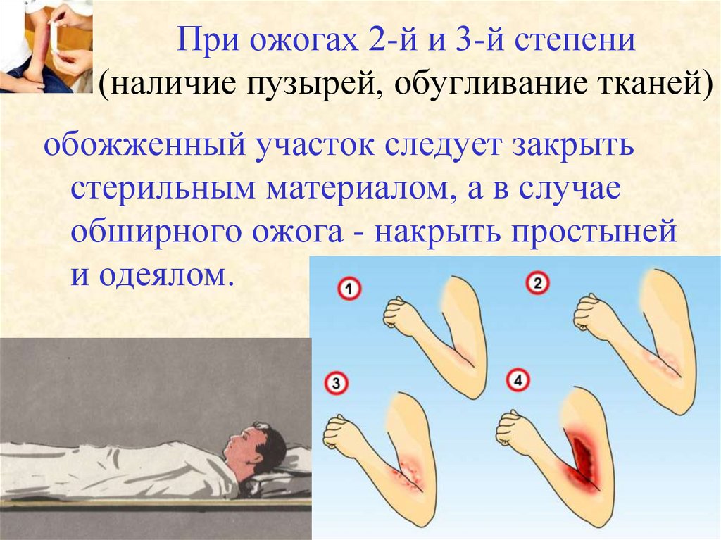 При ожогах 2-й и 3-й степени (наличие пузырей, обугливание тканей)