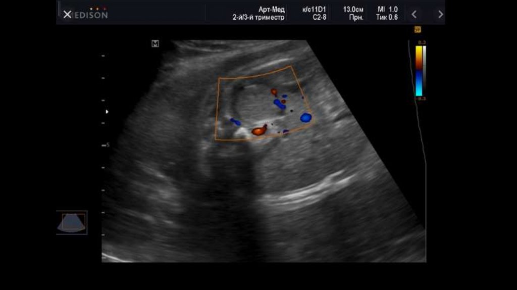 Ультразвуковое исследование надпочечников. Нейробластома надпочечника УЗИ. Опухоль надпочечников на УЗИ. Нейробластома надпочечника у детей на УЗИ. Надпочечник у плода на УЗИ.