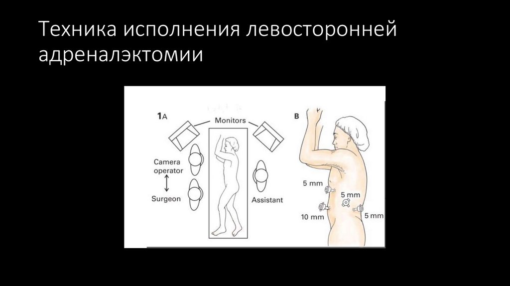 Техника исполнения левосторонней адреналэктомии