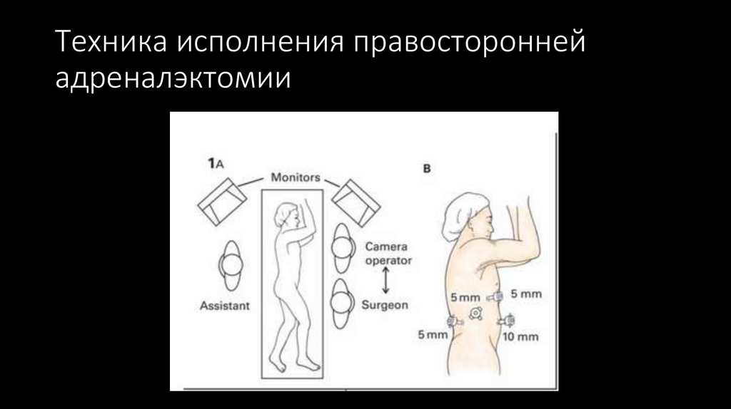Техника исполнения правосторонней адреналэктомии