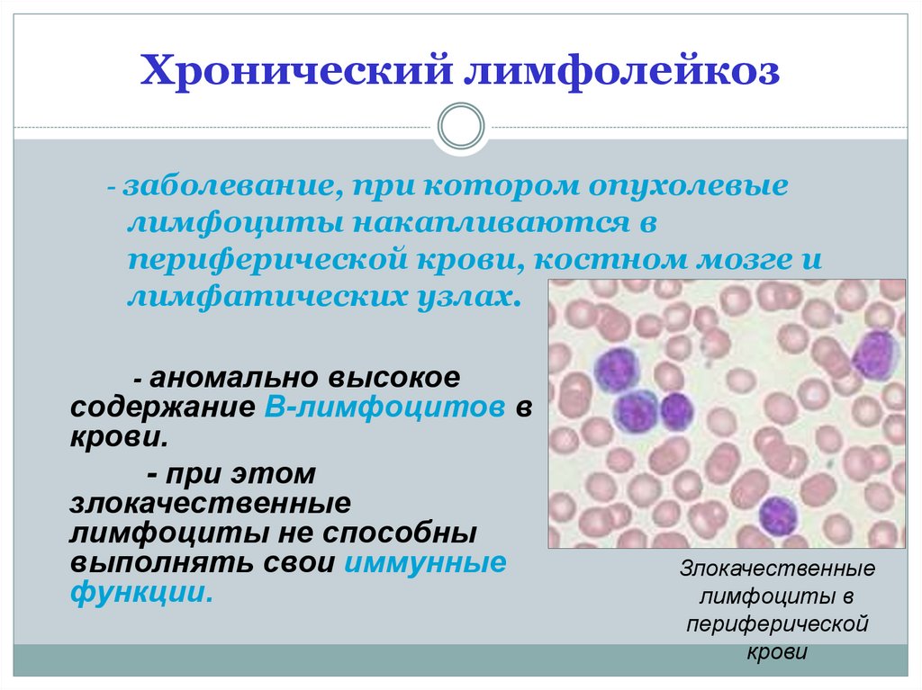 Лейкоз характеризуется. В -лимфоциты хронический лимфолейкоз. Хронический лимфолейкоз характеризуется. Хронический лимфолейкоз субстрат. Хронический лимфолейкоз и хронический миелолейкоз.