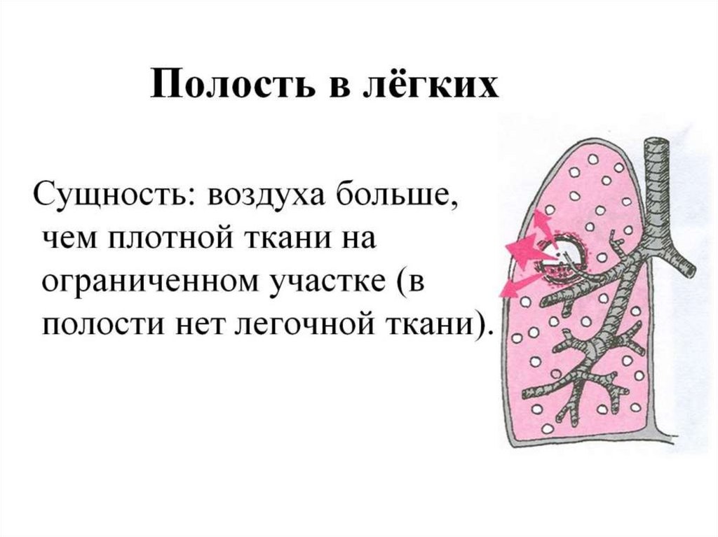 Полость в лёгких