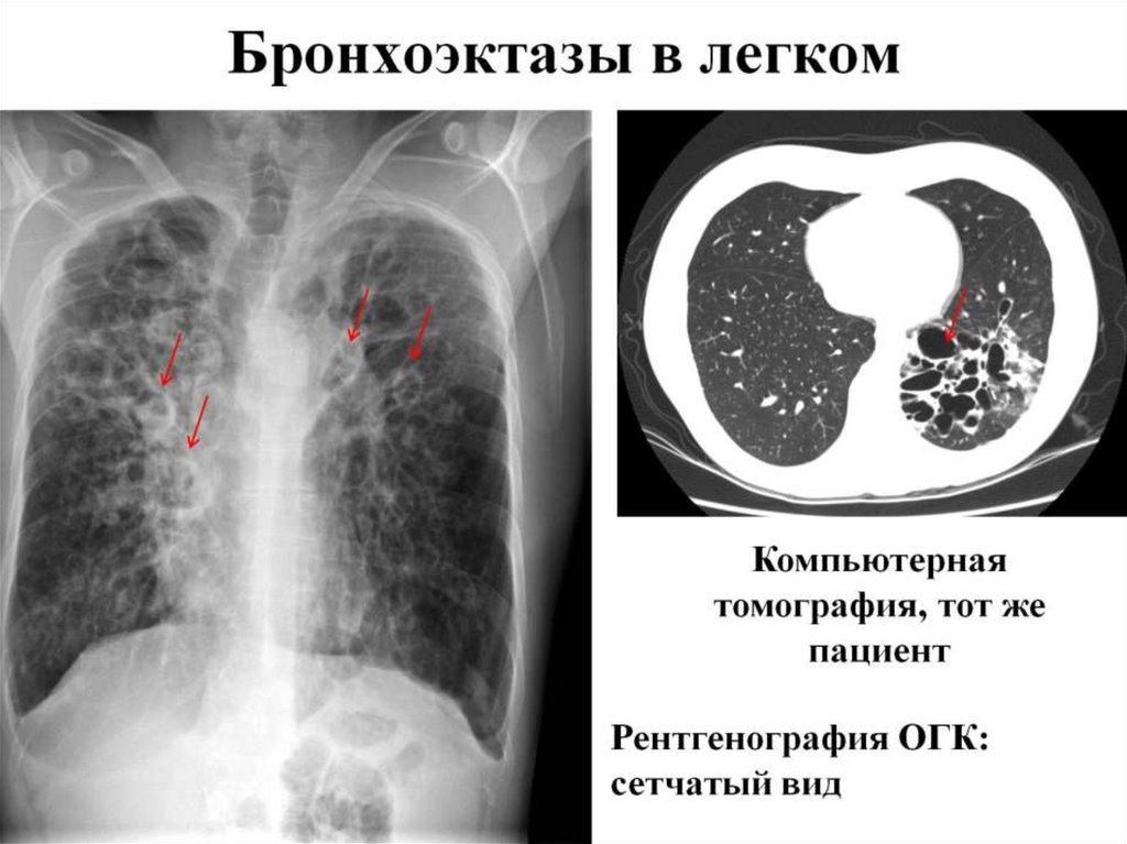 Бронхоэктазы в легком