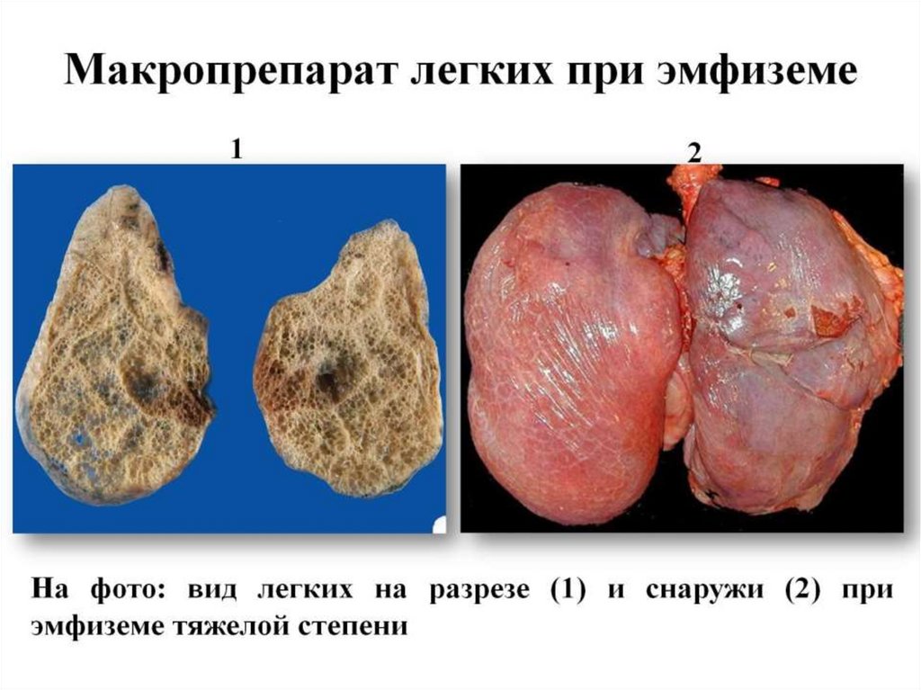 Макропрепарат легких при эмфиземе