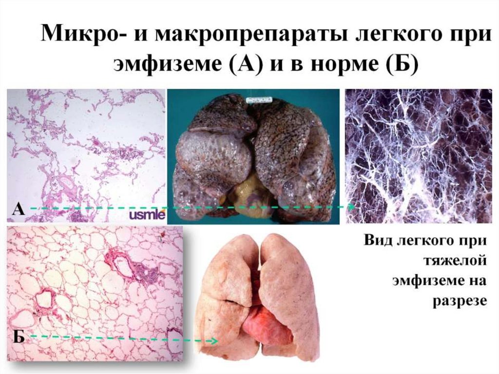 Микро- и макропрепараты легкого при эмфиземе (А) и в норме (Б)