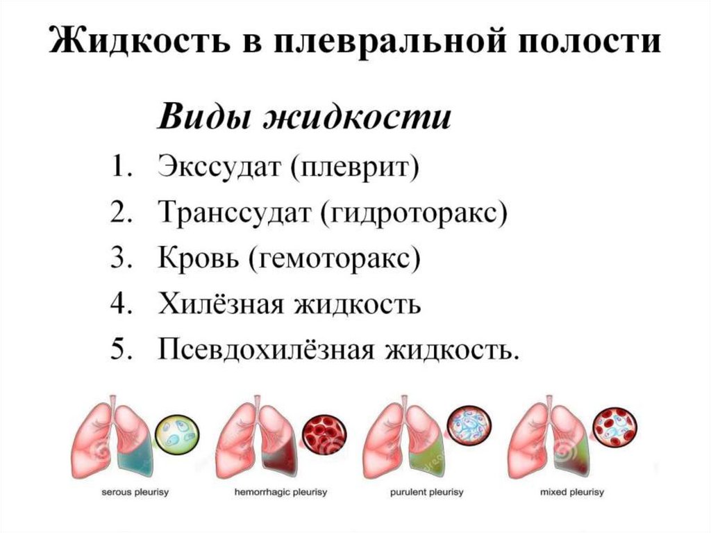 Жидкость в плевральной полости