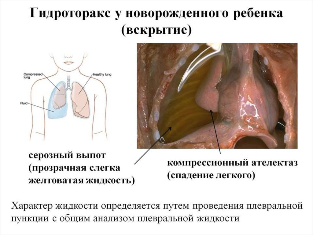 Гидроторакс у новорожденного ребенка (вскрытие)