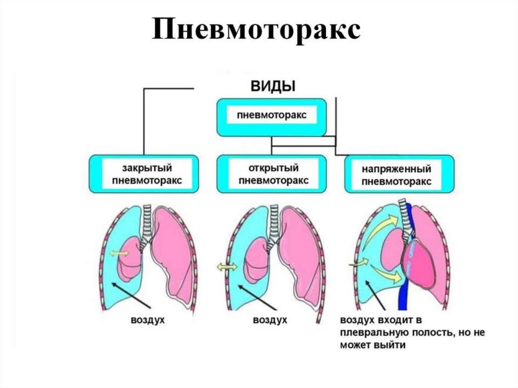 Пневмоторакс картинки для презентации