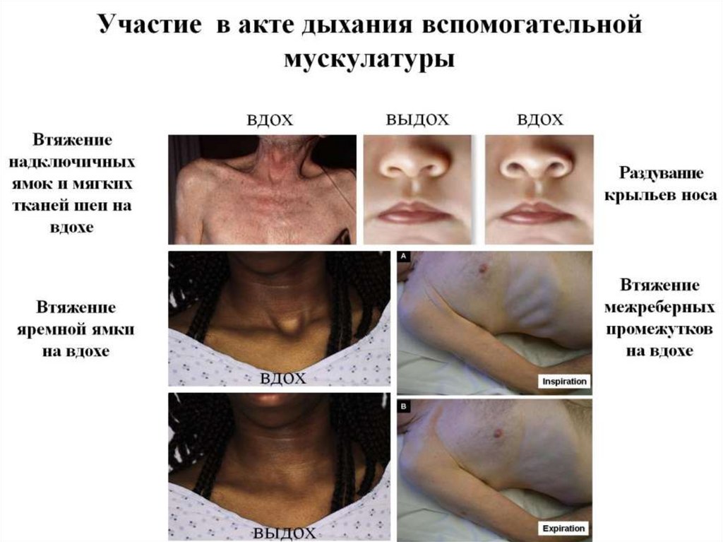 Участие в акте дыхания вспомогательной мускулатуры