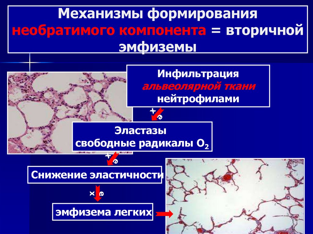 Острый бронхит карта вызова