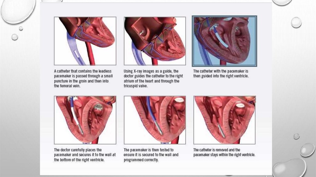 Техника операции