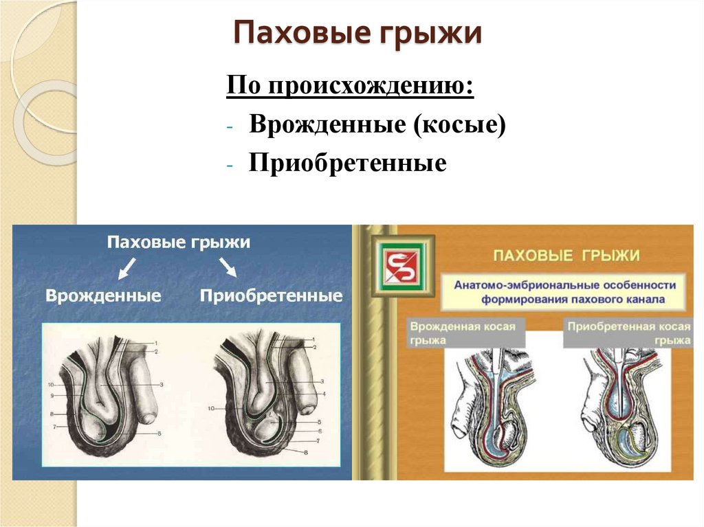 Ущемленная паховая грыжа у детей карта вызова смп