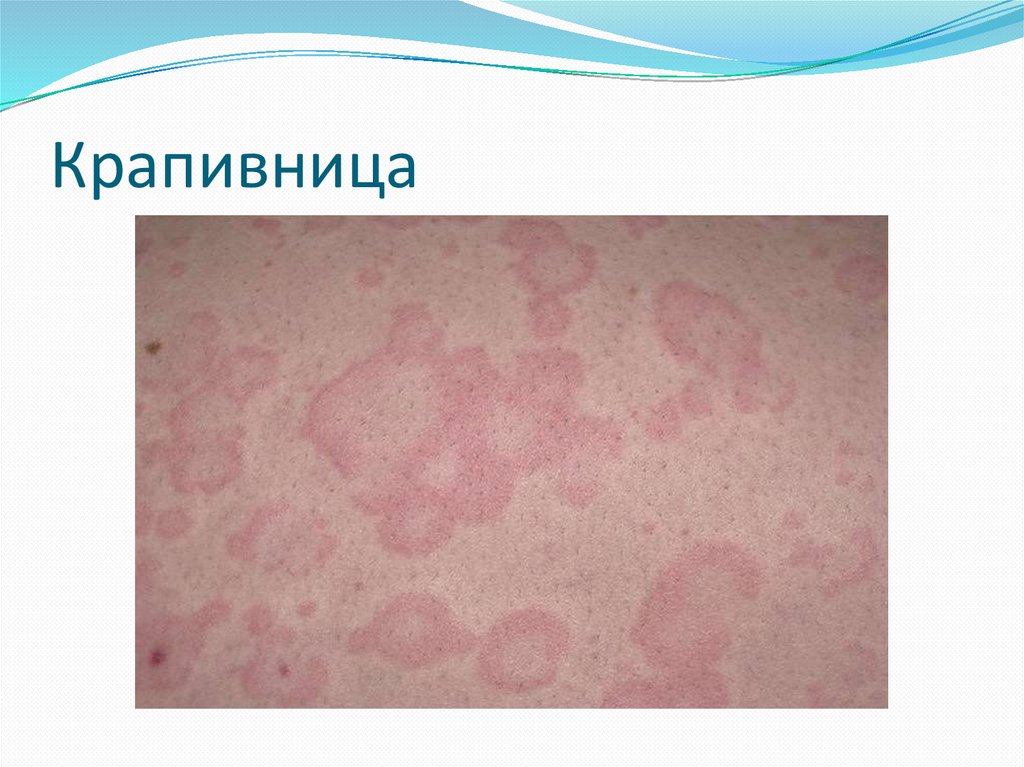 Крапивница - презентация онлайн