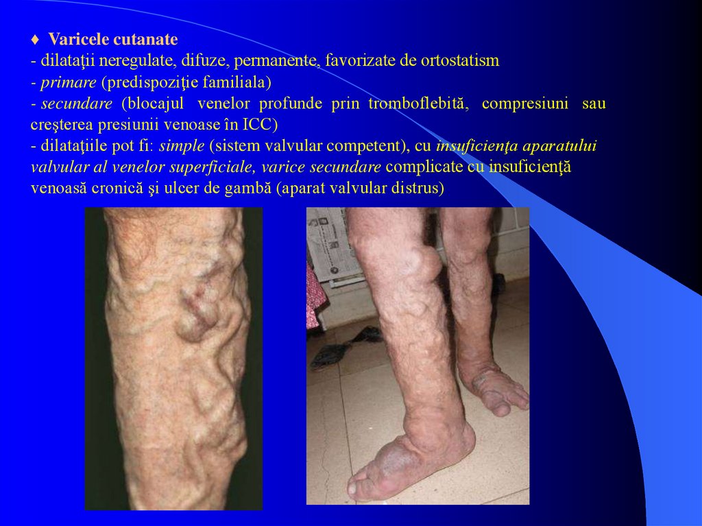 varicoza venelor mari ale extremităților inferioare prevenirea piciorului varicoasă