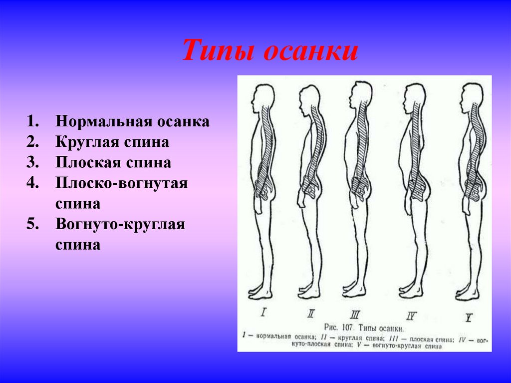 Правильная осанка - залог здоровья - презентация онлайн