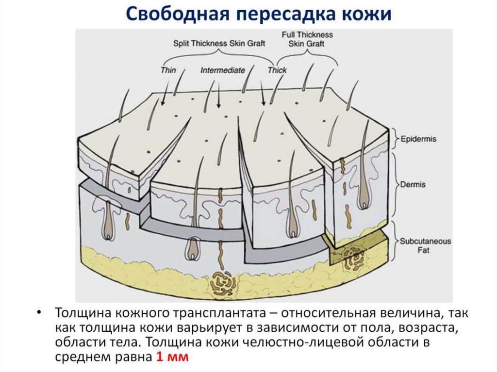 Свободная пересадка кожи