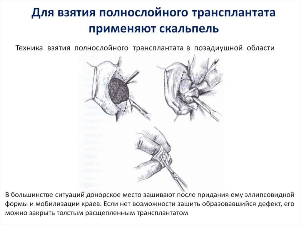 Для взятия полнослойного трансплантата применяют скальпель