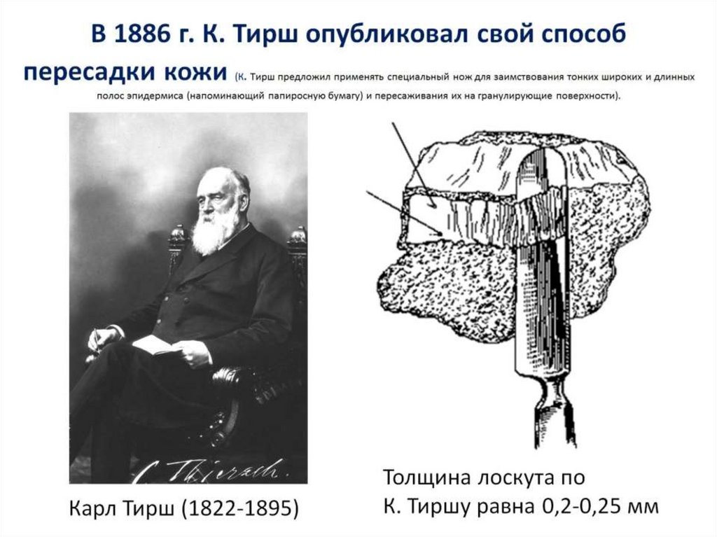 В 1886 г. К. Тирш опубликовал свой способ пересадки кожи (К. Тирш предложил применять специальный нож для заимствования тонких