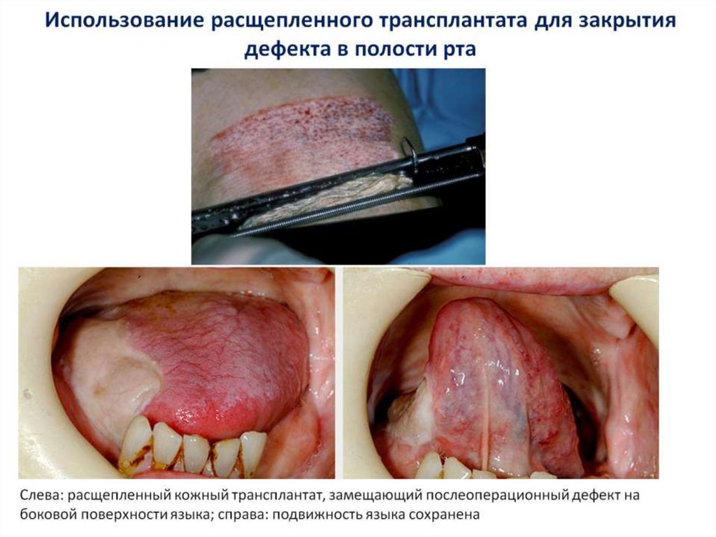 Использование расщепленного трансплантата для закрытия дефекта в полости рта