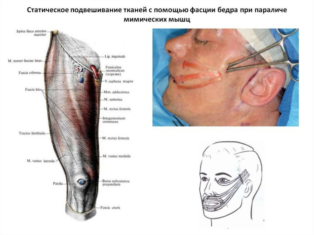 Статическое подвешивание тканей с помощью фасции бедра при параличе мимических мышц