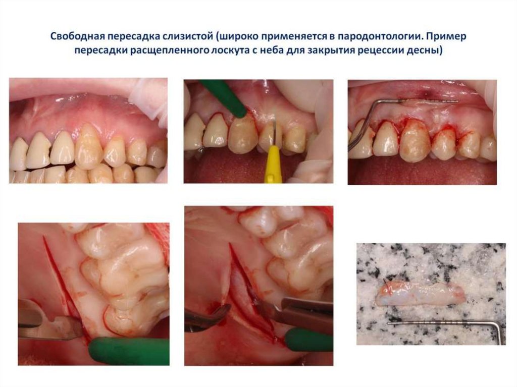 Свободная пересадка слизистой (широко применяется в пародонтологии. Пример пересадки расщепленного лоскута с неба для закрытия