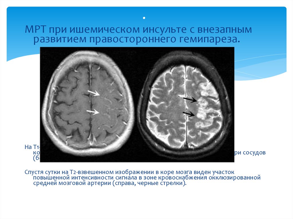 Правосторонний ишемический инсульт головного мозга. Т1 взвешенное изображение. Правосторонний гемипарез при инсульте. Гемипарез при ишемическом инсульте. Т1 и т2 взвешенные изображения.