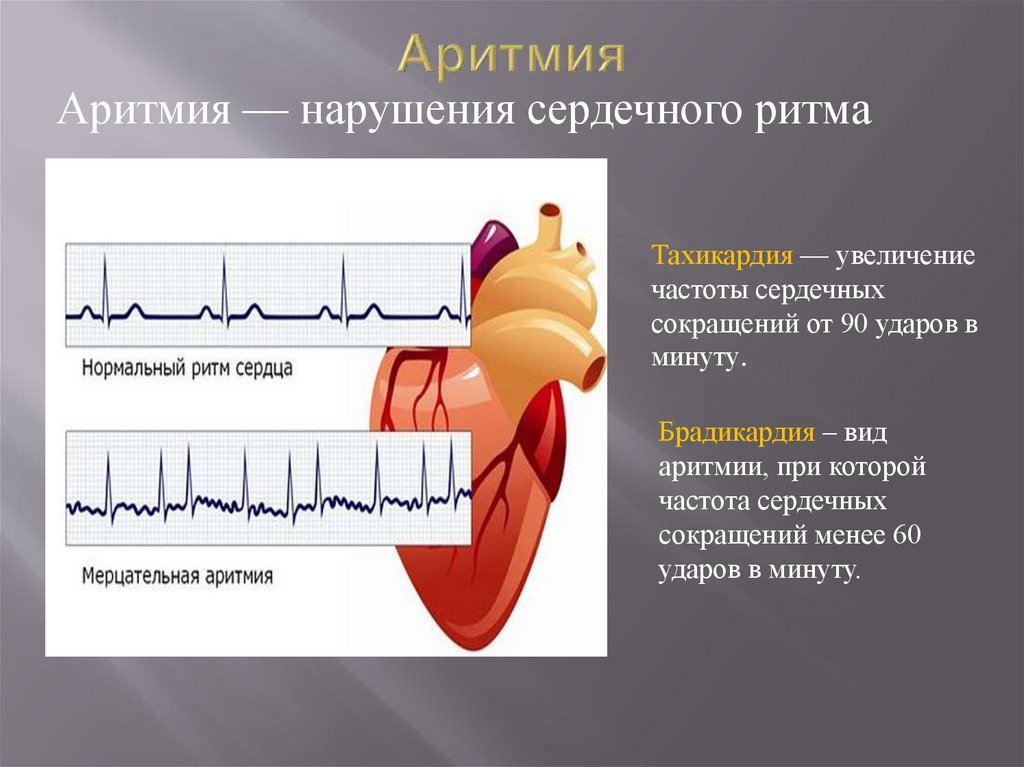 Аритмия у взрослых