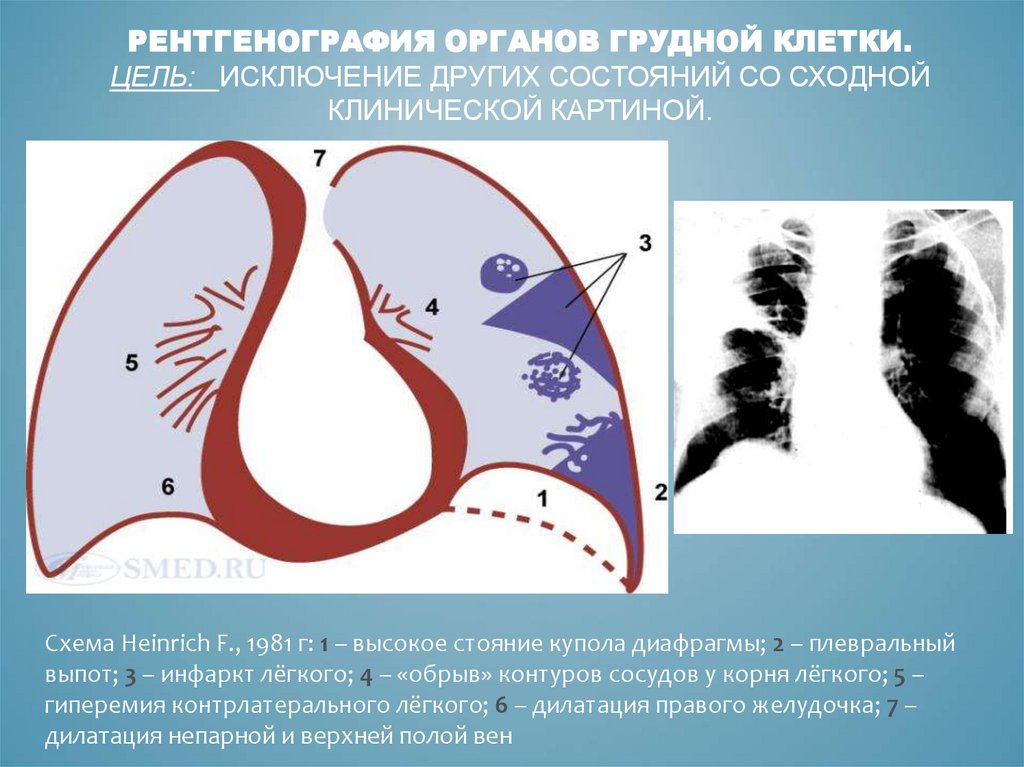 Стояние купола диафрагмы. Норма стояния купола диафрагмы. Высокое стояние диафрагмы причины. Рентгенография органов грудной клетки цель.