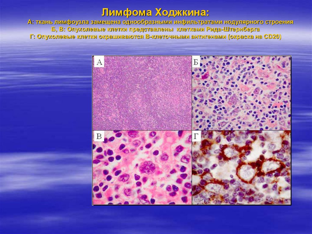 История лимфомы. Гемобластозы патологическая анатомия. Одноядерные клетки Ходжкина.