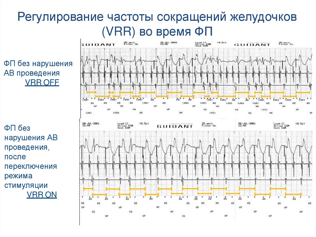 Уменьшение частоты. Частота сокращения желудочков. Частота желудочковых сокращений. Частота сокращений желудочков в норме. Желудочковые сокращения.