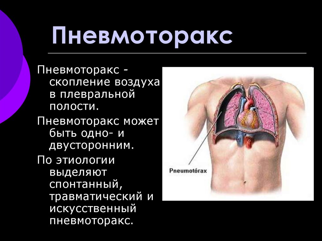 Понижение давления в плевральной полости. Пневмоторакс механизм нарушения дыхания. Открытый пневмоторакс дыхание. Заболевания при пневмотораксе.
