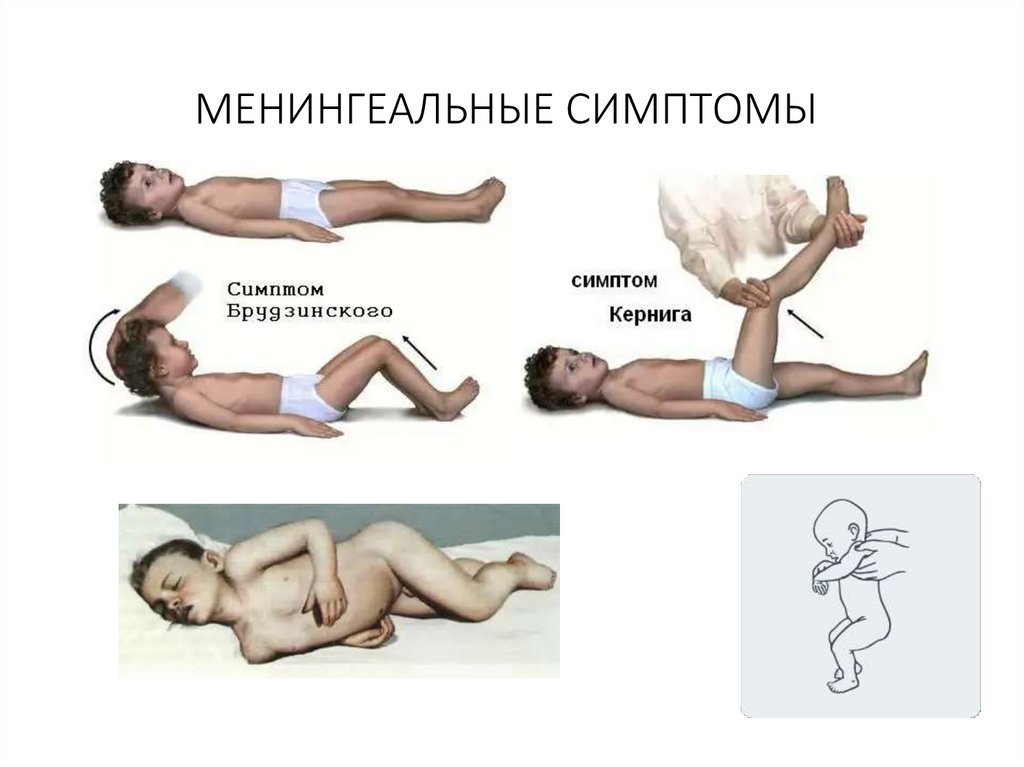 Менингеальные симптомы